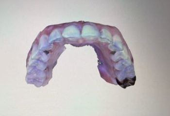Impression of teeth