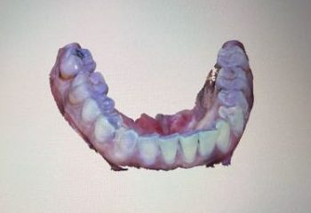 Impression of a row of teeth