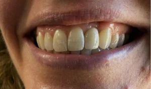 A smiling mouth with implants