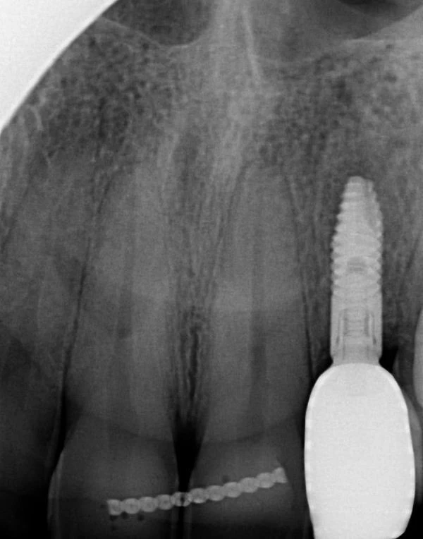 An xray of an implant