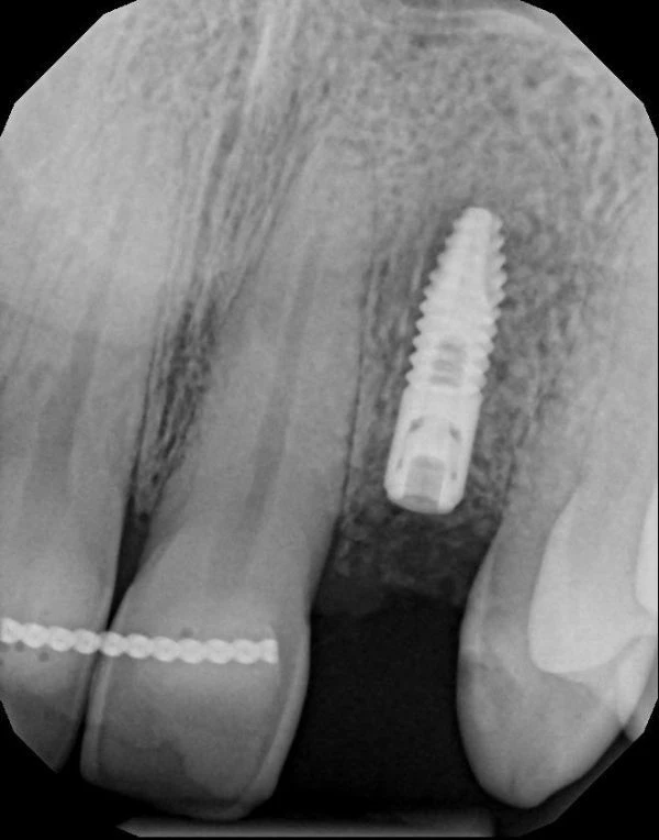 An xray of an implant